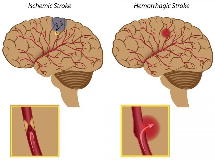 diagram-of-brain-strokes